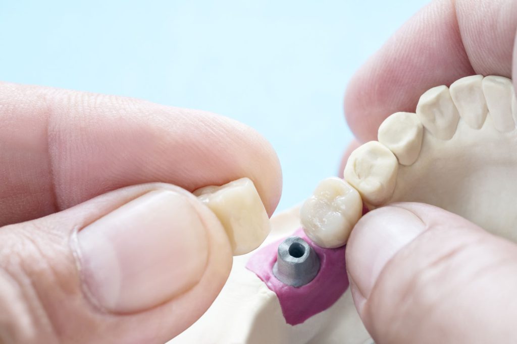 Protetyka stomatologiczna to dziedzina stomatologii zajmująca się przywracaniem brakujących zębów i ich funkcji za pomocą protez zębowych